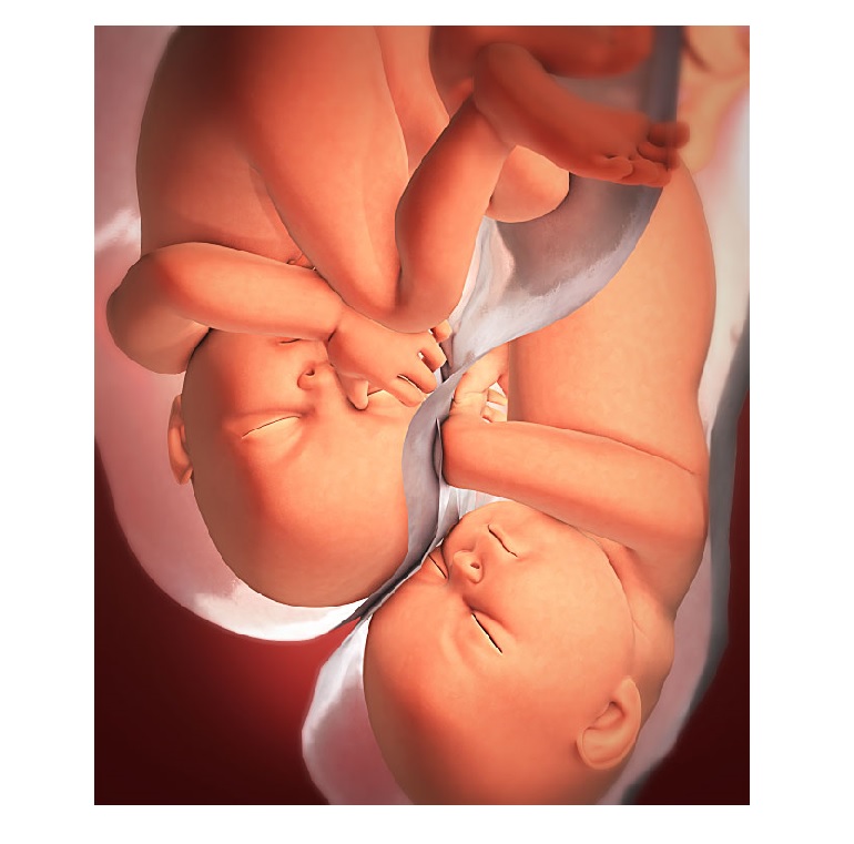 Успешное лечение бесплодия, а затем сохранение многоплодной беременности врачами КГБУЗ «КМКБ № 4».