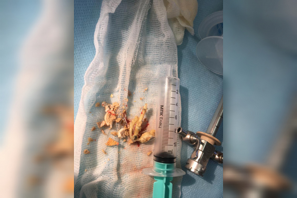 Врачи-урологи КГБУЗ «КМКБ № 4» удалили пациентке камень из мочевого пузыря, ядром которого была гинекологическая спираль.