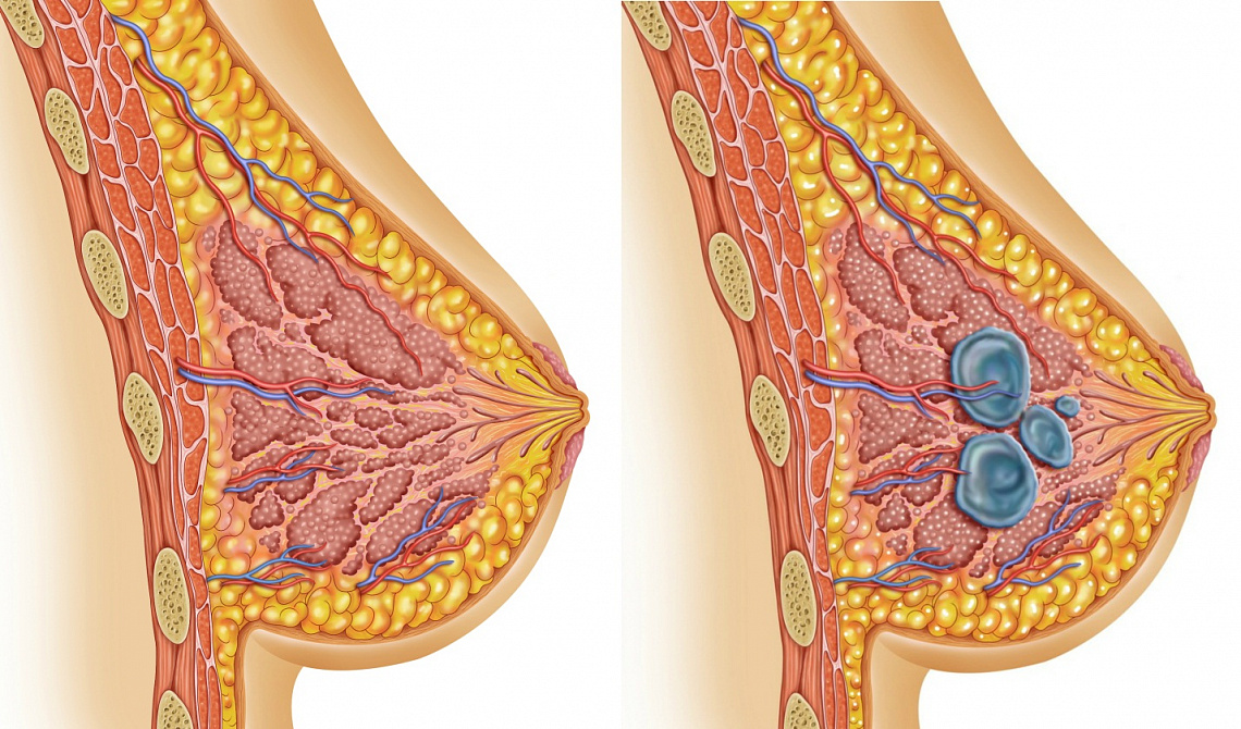 Мастопатия