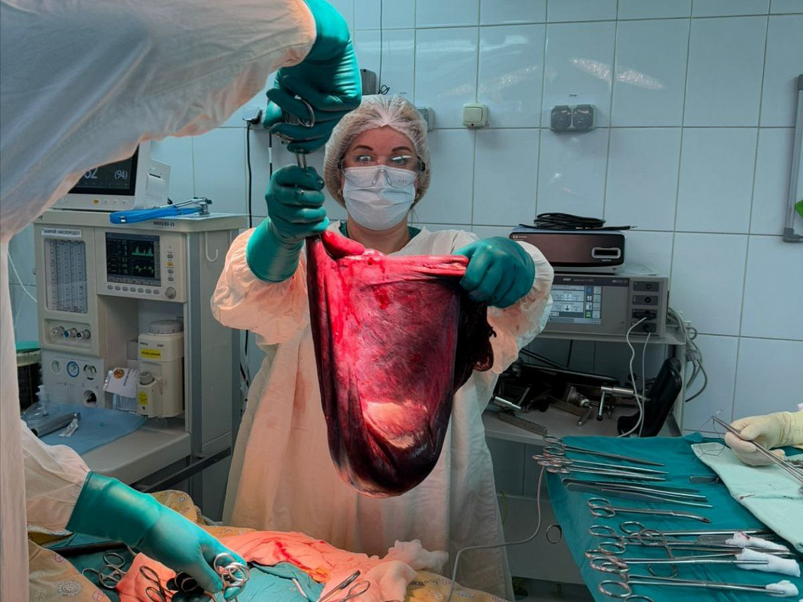 Врачи Больницы на Кутузова удалили пациентке цистаденому яичника гигантских размеров